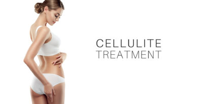 cellulite treatment toronto