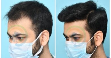 Hair Transplant Before After - 9 Months Results