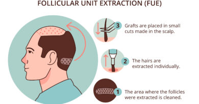 A New Era in Hair Restoration Minimally Invasive Boosted FUE Technique